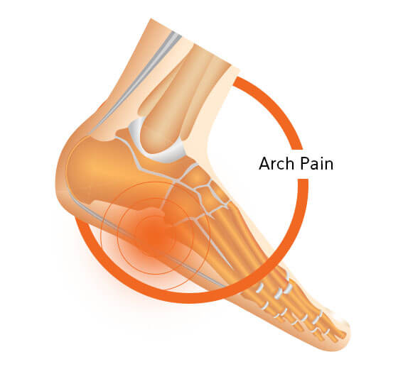 Arch Pain Foot Design