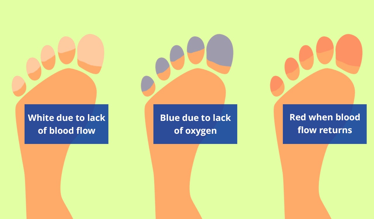 Diagrams showing the process of how Raynaud's affects the feet - toes turn white due to lack of blood flow, blue due to lack of oxygen, and red when blood flow returns.
